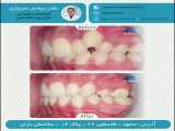 درمان ارتودنسی ثابت با کشیدن سه دندان دایمی