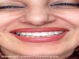 اصلاح طرح لبخند با کامپوزیت در دندانپزشکی یاس