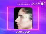قبل و بعد جراحی زیبایی بینی | دکتر سعید حسینی