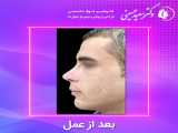قبل و بعد جراحی زیبایی بینی