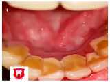 جرمگیری دندان در مجموعه دندانپزشکی کی ناز کلینیک