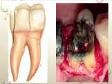 نگهداری یا کشیدن دندان از دیدگاه پریودنتولوژی بخش سوم ( دکتر خدا دوستان)