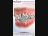 ارتودنسی به روش دیمون | کلینیک تخصصی دندانپزشکی کانسپتا 