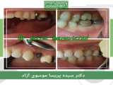 ایمپلنت دندان در رشت.دکتر پریسا موسوی آزاد.دندانپزشکی رشت