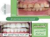 لمینیت دندان در رشت. بهترین دندانپزشکی در رشت. دکتر موسوی آزاد