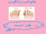 هالوکس والگوس به زبان ساده Hallux valgus