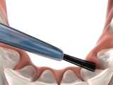 نگهدارنده ثابت ارتودنسی | کلینیک تخصصی دندانپزشکی کانسپتا 