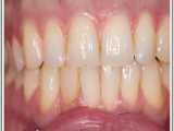 سفید کردن دندانها یا بلیچینگ | دکتر لیلا عطایی 