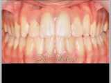 ارتودنسی بدون کشیدن دندان | دکتر احسان مهریزی 