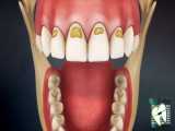 کامپوزیت کاربردهای خیلی گسترده‌ای در دندانپزشکی دارد | کلینیک دندانپزشکی ایده آل 