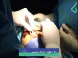 فیلم اتاق عمل جراحی بینی توسط دکتر بصام