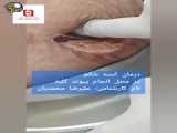 آموزش درمان آبسه شکم در محل انجام پیوند کلیه در کلینیک زخم در مشهد