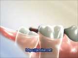 نحوه صاف کردن دندان عقل / متخصص ارتودنسی / دکتر جمیلیان 