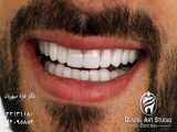 انواع لمینت دندان و بهترین انتخاب برای طراحی لبخند