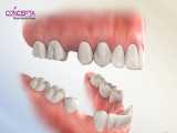 کشیدن دندان در ارتودنسی | کلینیک تخصصی دندانپرشکی کانسپتا