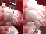 ارتودنسی روی دندان کامپوزیت شده | کلینیک دندانپزشکی ایده آل 