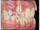 نامرتبی شدید دندانها | دکتر سعید قریشی 