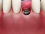 پیوند استخوان | کلینیک تخصصی دندانپزشکی کانسپتا 