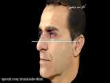 شبیه سازی جراحی بینی و عمل طبیعی مردانه