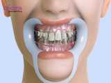آیا ارتودنسی محدودیت سنی دارد؟ | کلینیک تخصصی دندانپزشکی کانسپتا 