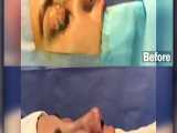 بلافاصله بعد از جراحی زیبایی بینی | متخصص گوش و حلق و بینی | دکتر محمد گلی 