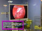 جراحی لاپاراسکوپی (کیست تخمدان) 