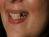 کامپوزیت دندان شیری