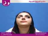 دو ماه پس از جراحی زیبایی بینی با انحراف تیغه بینی توسط دکتر فیروزه ضیاء متخصص گ