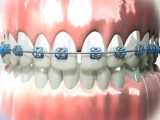جراحی فرنوم ( فرنکتومی ) | کلینیک تخصصی دندانپزشکی کانسپتا 