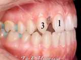 فضای بسته شده ناشی از فقدان مادرزادی دندان لترال (پیشین طرفی) | کلینیک کانسپتا 