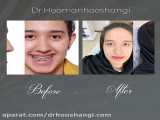 جراحی فک و چانه | رفع مشکل لبخند لثه ای |  دکتر هومن هوشنگی