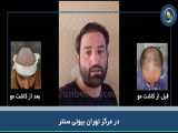 برای اولین بار در ایران از بین بردن موهای نازک