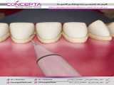 آیا جرمگیری به دندان آسیب می‌زند؟ | کلینیک تخصصی دندانپزشکی کانسپتا