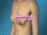 جراحی سینه مردان_ژنیکوماستی 
