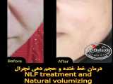 درمان خط خنده