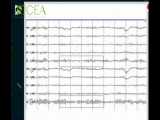 معرفی EEG یا الکتروانسفالوگرافی