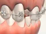 درمان ارتودنسی به همراه ایمپلنت | کلینیک تخصصی دندانپزشکی کانسپتا 