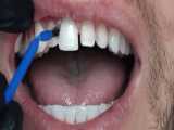 درمان لمینیت سرامیکی | کلینیک تخصصی دندانپزشکی کانسپتا 
