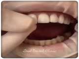 مراحل درمان لمینت سرامیکی | کلینیک دندانپزشکی ایده آل