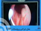 عمل جراحی پروستات TURP 