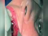 فیلم واقعی کاشت ایمپلنت دندان 