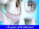 درمان لبخند لثه ای (جراحی فک) | دکتر احسان مهریزی 