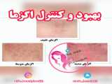 بهبود و کنترل اگزما