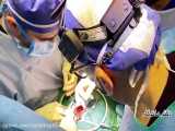 عمل جراحی تعویض دریچه آئورت از شکاف کوچک شش سانتی(minimally invasive)