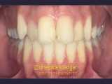 درمان ارتودنسی ثابت همراه با کشیدن یک دندان | دکتر سپیده دادگر 