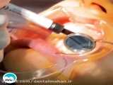انجام بلیچینگ فک بالا در کلینیک دندانپزشکی ماهان | بلیچینگ دندان