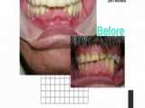 اصلاح سایش دندان ها - نمونه کار دکتر غزال آرش راد