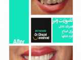 کامپوزیت ونیر همرنگ دندان - دکتر غزال آرش راد