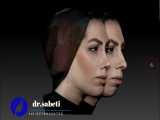 طراحی سه بعدی قبل از عمل بینی و چانه-دکتر ثابتی