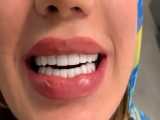 اصلاح طرح لبخند | کلینیک دندانپزشکی دکتر الهه صادقی